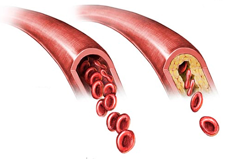 Warning Signs of Clogged Arteries